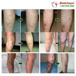 varicose veins cream