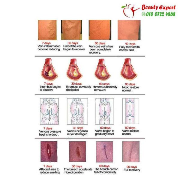 كريم لعلاج دوالى الساقين